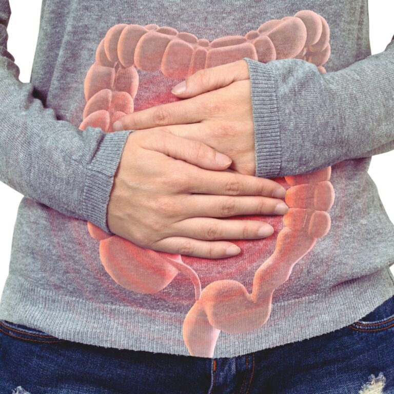 Irritable bowel syndrome – an overview of symptoms, causes, and treatment